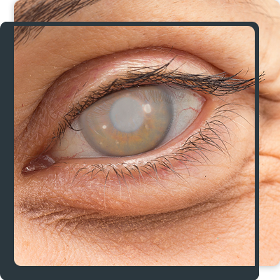 Cataract corrective surgeries UAE